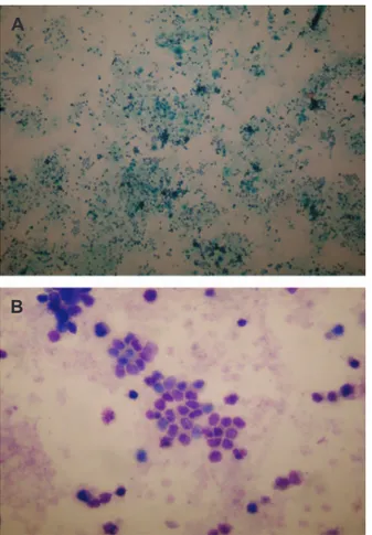 Fig 3: The tumor cells express pancytokeratin and neuroen- neuroen-docrine markers (Kromogranin; ×100 ).