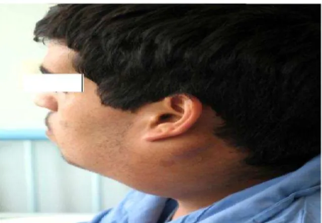 Fig 2: Hypoglossal palsy is shown 