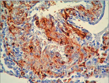 Figure 4: he positive stain of HMB-45 prominent in the  epithelioid cells (immunoreactivity; x400)