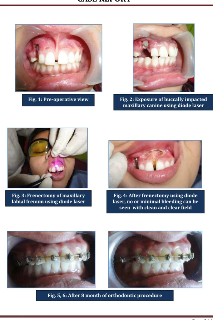 Fig. 1: Pre-operative view  Fig. 2: Exposure of buccally impacted  maxillary canine using diode laser 