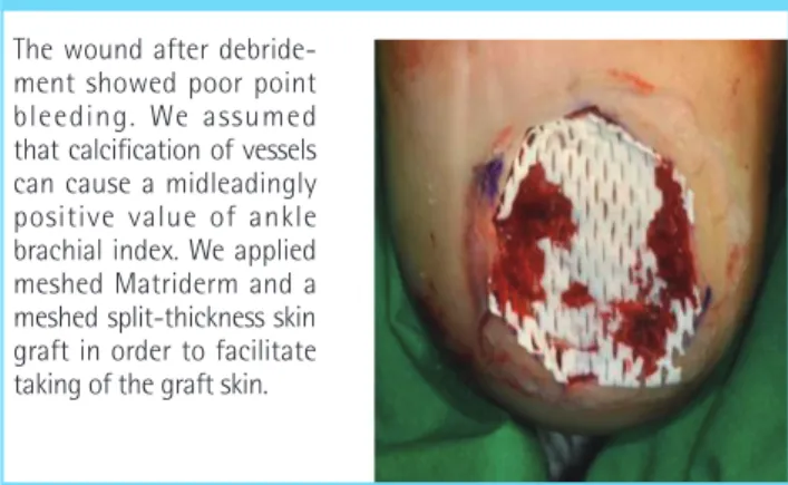 Fig. 5. Meshed Matriderm appliance with poor vascular  condition