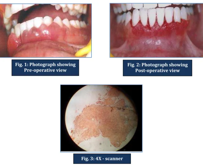 Fig. 4: 10 X- low power view: Showing hyperplastic stratified squamous epithelium with underlying  connective tissue stroma showing increased collagen fibers and intense inflammatory cell infiltrate in  diffuse pattern