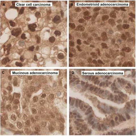 Figure 5. Microcephalin expression in different EOC subtypes. A. Clear cell carcinoma and B