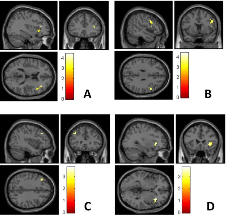 Fig 1. Reactivity in the right inferior frontal gyrus (A, B), left middle frontal gyrus (C) and right insula (D) during emotional stimulation was more pronounced in late postpartum than in early postpartum in 13 healthy newly delivered women