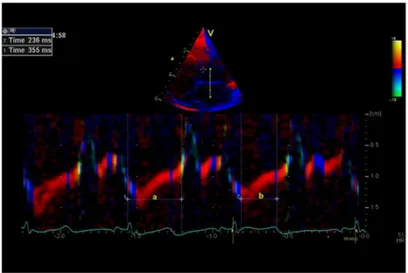 Fig 1. Myocardial Performance Index (MPI) derived by color tissue Doppler echocardiography