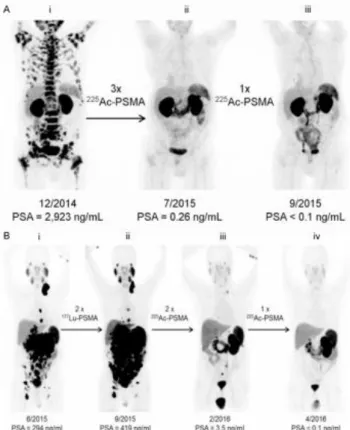 Figure  1.1.  (A)  68 Ga-PSMA-11  PET/CT  scans  of  a  PCa  patient.  Pretherapeutic  tumor  spread  (i),  restaging  2  months  after  third  cycle  of  225 Ac-PSMA-617  (ii),  and  restaging  2  months  after  one  additional consolidation  therapy (iii