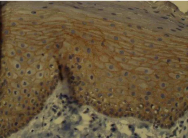 Table 1: Clinico-pathological profile of 28  patients with head &amp; neck squamous cell 