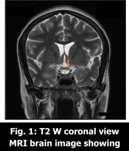 Fig. 1: T2 W coronal view  MRI brain image showing 