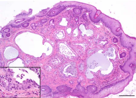 Fig 7. Photo of hematoxylin and eosin — stained histopathology slide of ceruminous gland dysplasia in a Santa Catalina Island fox (main image scale bar = 200 μm, inset = 50μm).