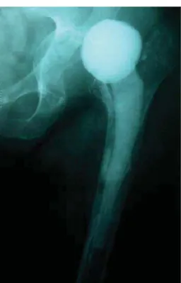 Fig. 2 – Dislocated hip spacer.