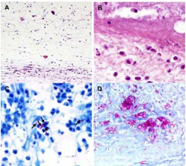 Figure 6. Histologic sections of mouse footpads infected with M. ulcerans 00-1441. BALB/c (A–C) and NMRI (D) mice were infected subcutaneously with 5.4 log 10 M