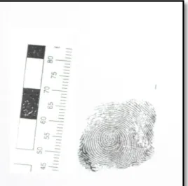 Figura 14- Pulpite fissurada dos dedos (Impressão digital recolhida)