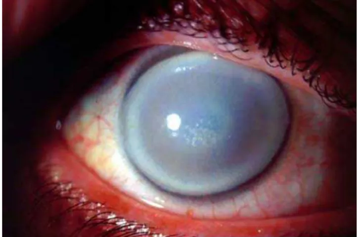 Figure 1. Slit lamp image of the right cornea from a 50-year old affected member of family 105, demonstrating a ‘‘bull’s eye’’