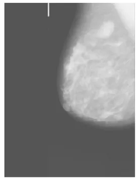 Fig. 2a The original mdb015 image.  Fig. 2b The mdb015 image was adjusted  with the increased of brightness