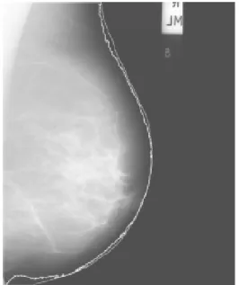 Fig. 3e Lines from first and second tracings  (grey and white respectively) were  superimposed on the adjusted mdb014 