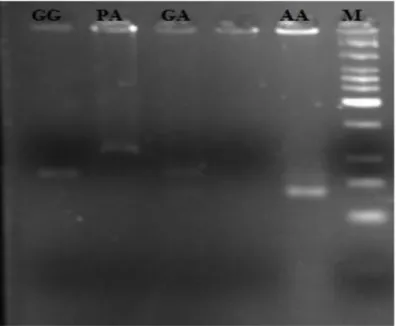 Figura  5  -  Gel  de  restrição  do  gene  COMT.  1  -  um  individuo  GG  (com  uma  banda  de  89bp),  2-  Produto  de  amplificação  (111bp);  3-  individuo  GA  (com  uma  banda  de  89,  71bp);  5-  indivíduo  AA(71bp); 6 - marcador de pesos molecula