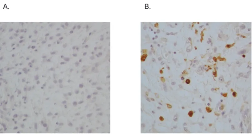 Fig 7. Comparison of the biopsy specimens obtained before chemotherapy and the resected specimens obtained after chemotherapy
