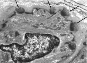 Fig 2. Electron microscopy of skin biopsy shows electron dense granular deposits (arrows) in the basal lamina surrounding vascular smooth muscle cells.