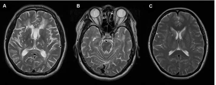 Fig 3. (A): Axial T2W MRI brain of a symptomatic subject (II-9) demonstrates cerebral atrophy