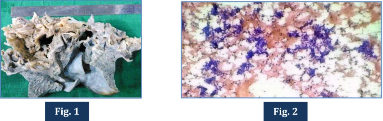 Fig.  1:  Gross  image  of  the  pneumonectomy  specimen  received  showing  gray  white  friable  areas  representing the mass