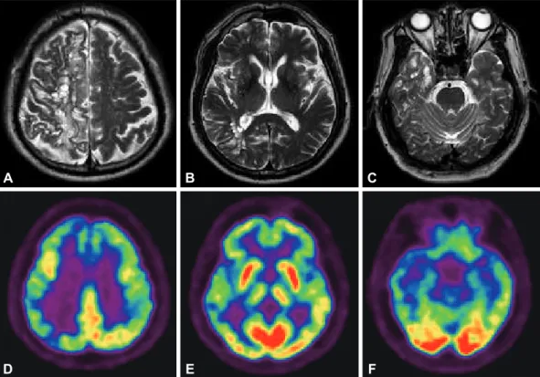 Figure 1. T2-weighted brain magnetic resonance imaging studies show mixture of high signal intensity lesions and  numerous round and septate cystic lesions in the (A) right high cerebral convexity and (B and C) temporal lobes