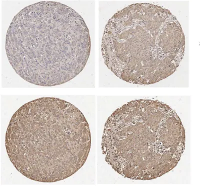 Fig 6. SIPL1 protein expression correlates with increased AKT activation in primary BC