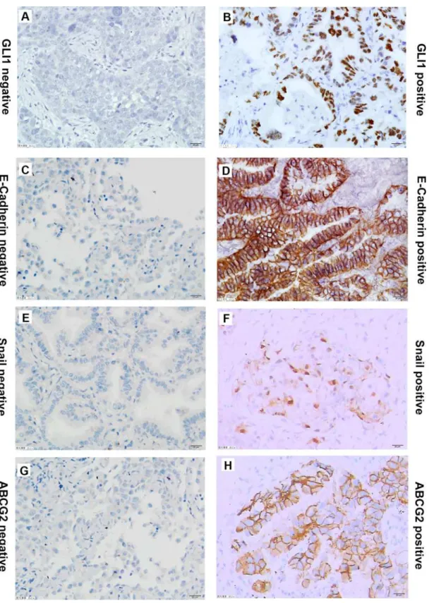 Fig 4. Representative immunostaining of GLI1, ABCG2, E-Cadherin and Snail in NSCLC tissues