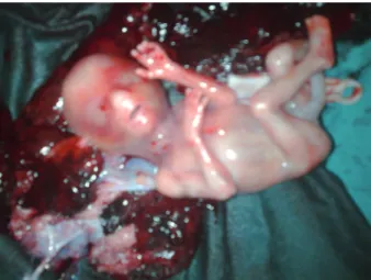 Figure 1. Intra-operative photograph showing the poste- poste-rior view of the uterus with ruptured rudimentary horn