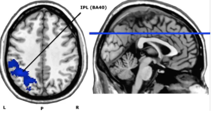 Fig 5. Axial view of whole brain activity found with the paired t -test (contrast Before &gt; After HF-rTMS treatment), overlaid on an anatomical T1-image