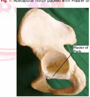 Fig. 1:  Acetabular notch packed w it h Plast er of  Par is.