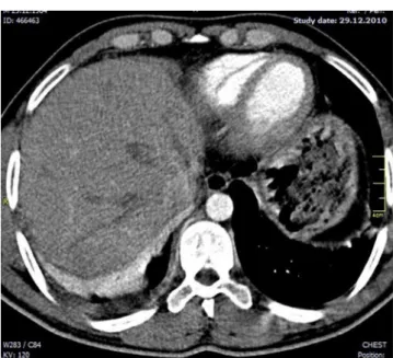 Figure 2. Computerized tomography of the thorax shows atelectasis in the right  lower lobe and pleural efusion