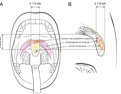 Figure 3. Palatal implant surgery. (A) Preoperative frontal view demonstrating the 3 operative sites of the soft palate (0.5 cm below the hard palate-soft palate junction; 0.2 cm between the midline and para-midline sites)