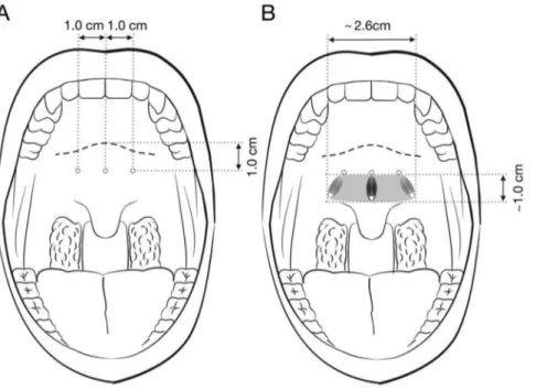 Table 1 summarizes baseline anthropological data, polysomno- polysomno-graphic parameters, and subjective snoring questionnaire scores for the entire study cohort