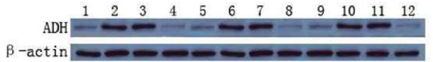 Figure 3. Efect of low concentrations of ethanol on expression of ADH using Western blot analysis in gastric adenocarcinoma cell  lines (MGC803, BGC-823, and SGC7901)