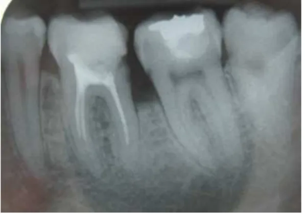 Fig. 4. Tooth 2.6. with chronic marginal periodontitis,  associated with tertiary dentin deposition especially 