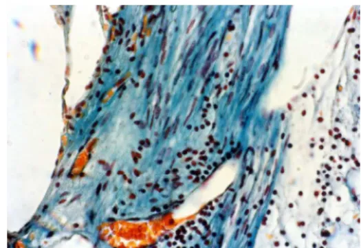 Fig. 6. Pulp calcifications can be unique, multiple to the same tooth (4.4.) or to multiple teeth, at the same patient     To highlight such pulp changes, pulp  frag-ments were sampled and processed for  micro-scopic examinations, from the teeth with sever