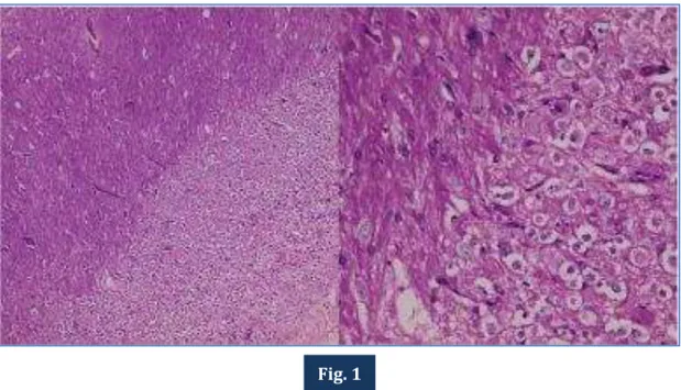 Fig. 1: Histopathology section showing widening of the molecular layer, absence of the Purkinje cell  layer  and  hypertrophy  of  the  granular  cell  layer  containing  dysplastic  ganglion  cells