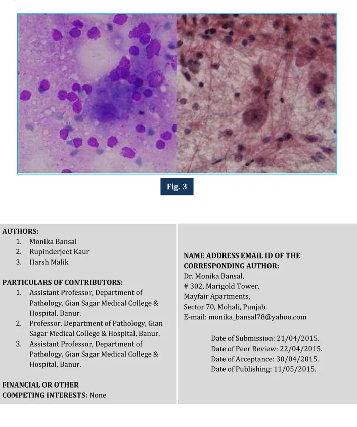 Fig.  3: Squash  smears  showing  large  ganglion  cells  having  vesicular  nuclei,  prominent  nucleoli  and  thick  cytoplasm  along  with  small  dark granular  cells  in  a  fibrillary  background