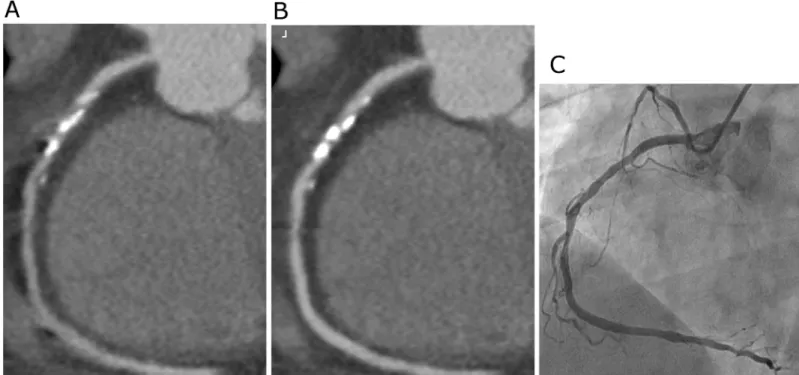 Fig 2. Example of a 57-year-old man (body weight 78 Kg, heart rate 65 beats/min) underwent prospective scan, curved multiplanar reconstruction images of the right coronary artery (RCA) using conventional reconstruction technology (A) and the new motion-cor