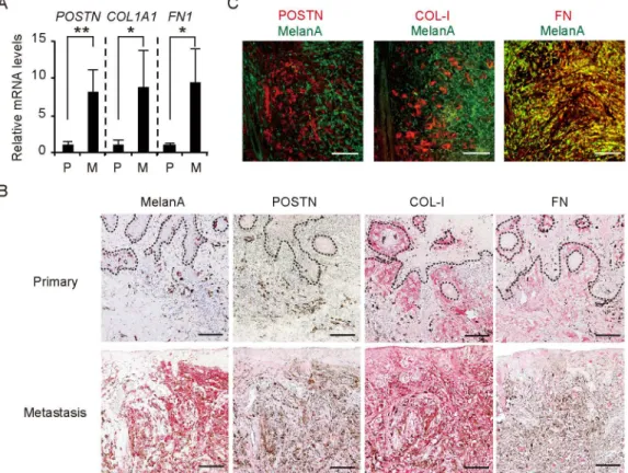 Fig 2. Overexpression of POSTN, COL-1, and FN in the stroma of wound metastasis in a melanoma patient