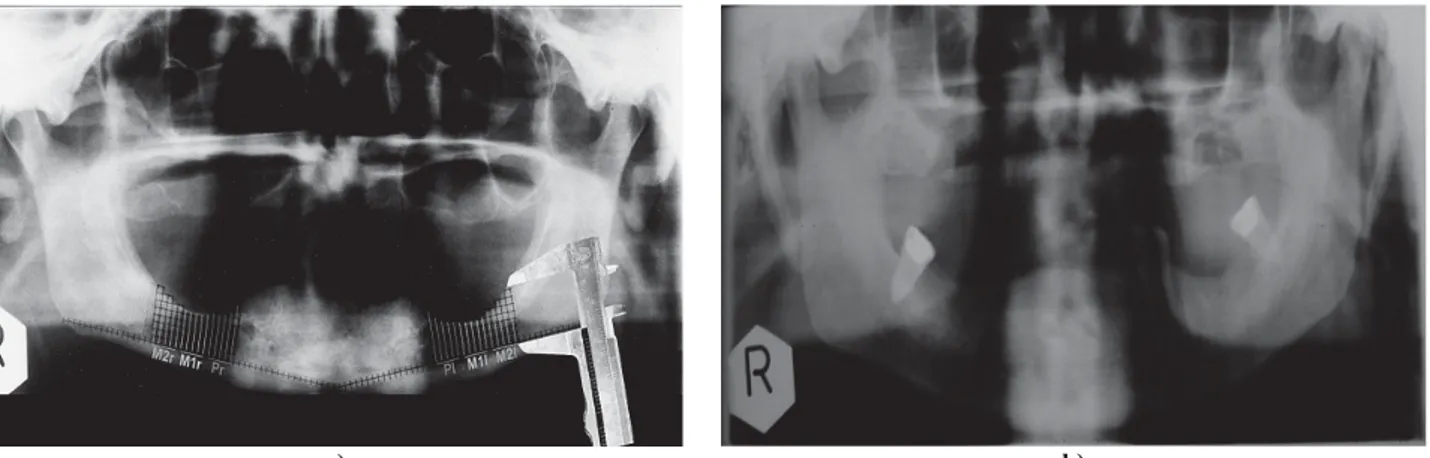 Fig. 1 – a) A grid positioned in the regions of particular interest for panoramic radiograph of osteoporotic edentulous mandi- ble and the determined regions – Pr, M1r, M2r, Pl, M1r, M2r (Pr – region of missing premolar to the right side of the  mandi-ble;