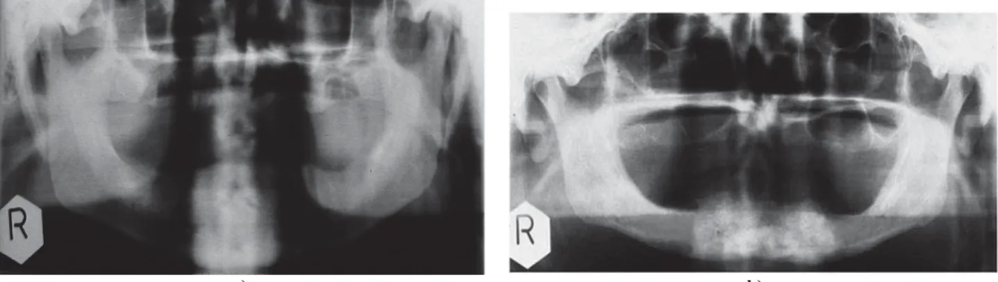 Fig. 3 – a) Panoramic radiograph of the control group patient after application of calcitonin and calcium solution;