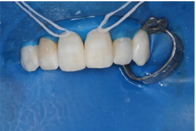 Figura 2- Fechamento de diastema. 