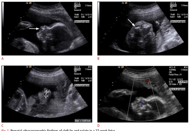 Fig. 1. Prenatal ultrasonographic indings of cleft lip and palate in a 27-week fetus.