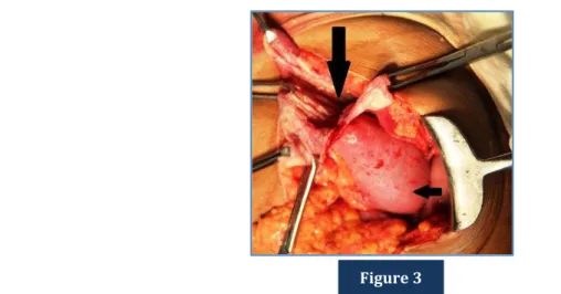 Figure 4: Surgical specimen exhibited multiple daughter cysts. 