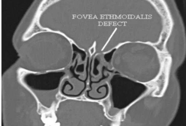Fig 2: Endoscopic view of the dural defect 
