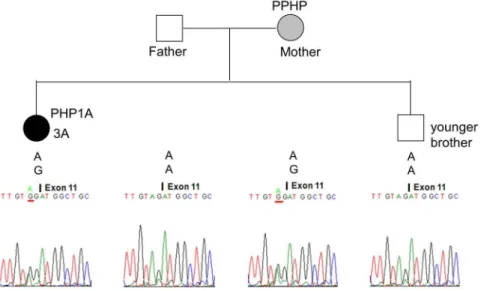 Figure 6. Pseudohypoparathyroidism 1a (PHPIA) caused by the c.1027_1028delGA mutation in Family 4