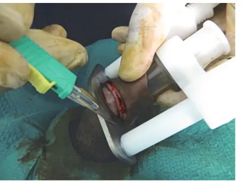 Fig 2. Excising the foreskin.