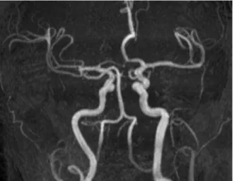 Şekil  .  MR  anjiografi  görüntülerinde  sol  po sterior  serebral  arterin P  segmenti izlenmedi