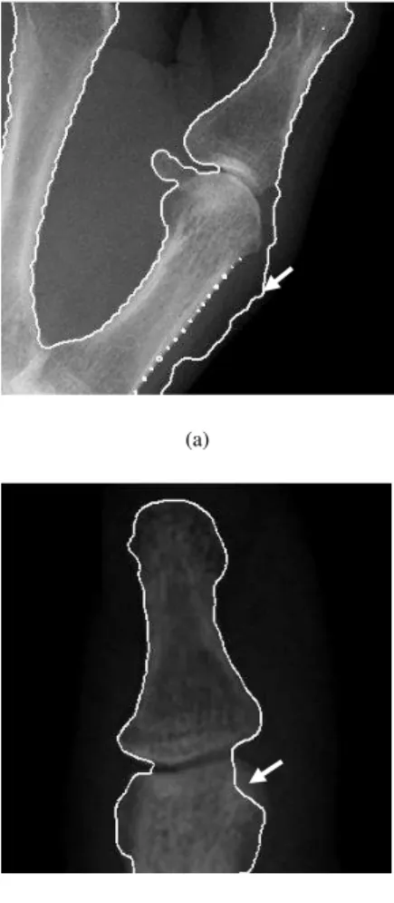 Fig. 3. An  example  of  the  failed  detection  boundary  result  by  a  snake  method with a certain initial contour